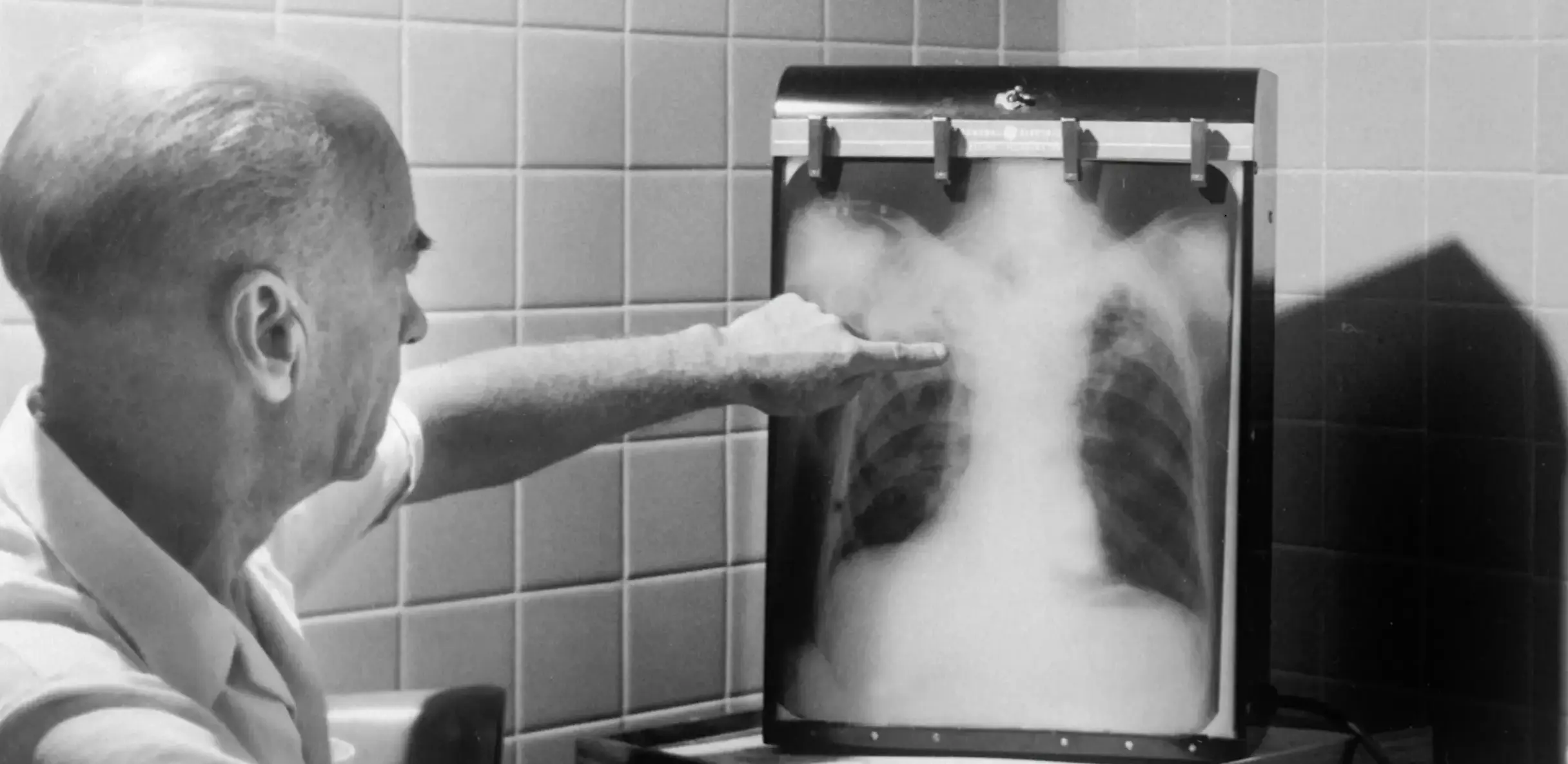 tuberculosis